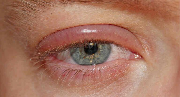 Demodectic mange on the eyelids